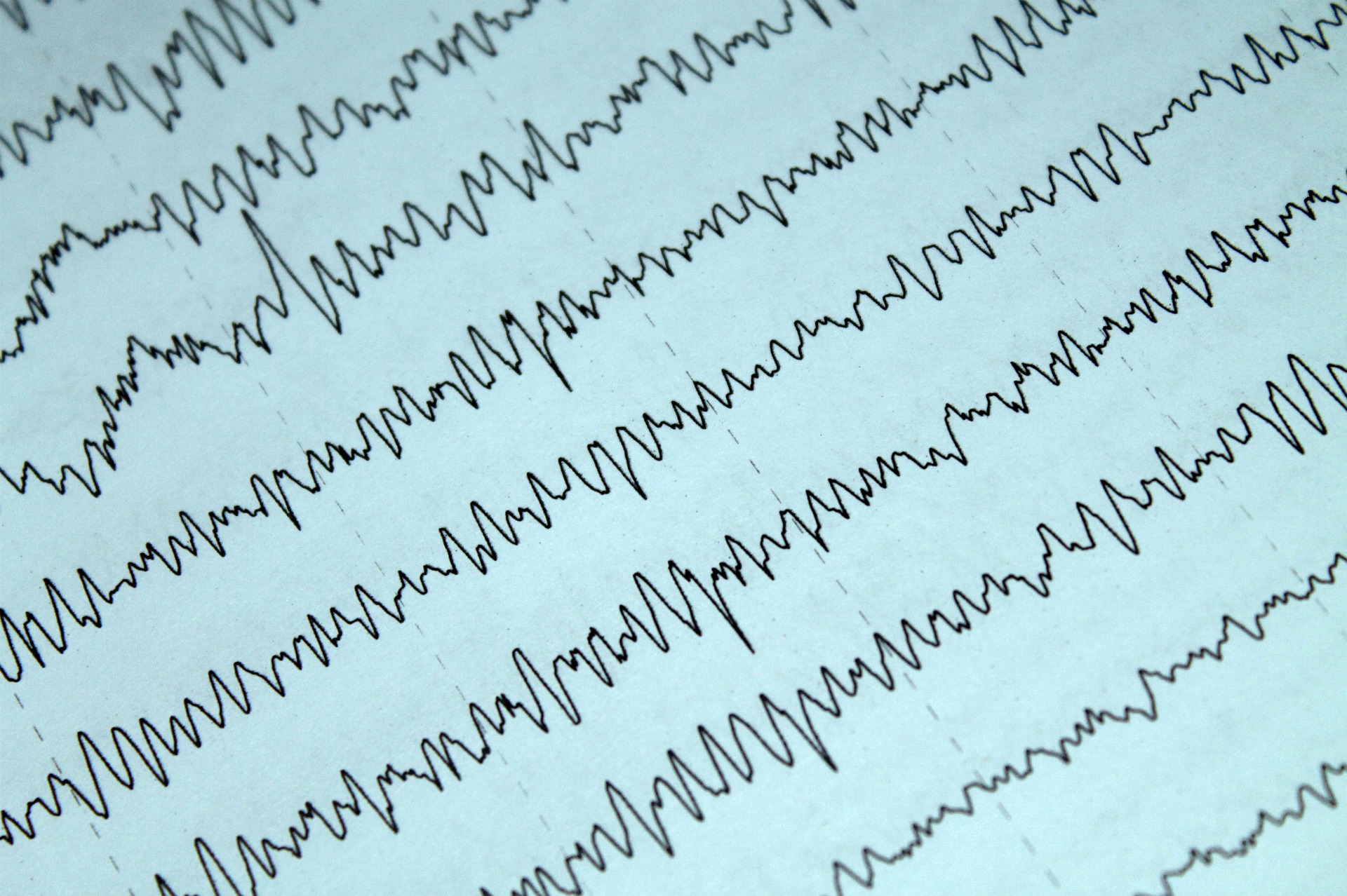 Minimally invasive techniques for the treatment of Refractory Epilepsy